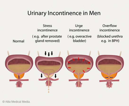 Incontinence - Prostate Conditions